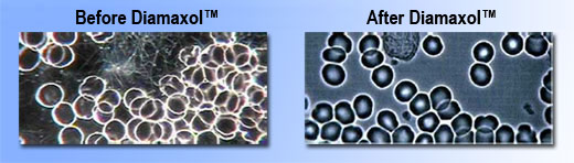 Picture shows high serum glucose and debris of protein fats